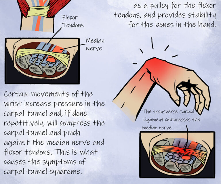 This subsection of a page is from a class project created by Shayla Sackinger. There are two images showing a cross section of a human wrist with tendons, bones, and nerve fibers. Part of the text reads: certain movements of the wrist increase pressure in the carpal tunnel and, if done repetitively, will compress the carpal tunnel and pinch against the median nerve and flexor tendons. This is what causes the symptoms of carpal tunnel syndrome. One of the cross section images is labeled with text: The transverse carpal ligament compresses the median nerve.